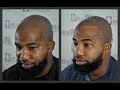 Scalp Micropigmentation African American Edge-Up