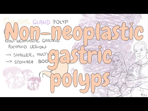Video: Diet for polyps in the stomach