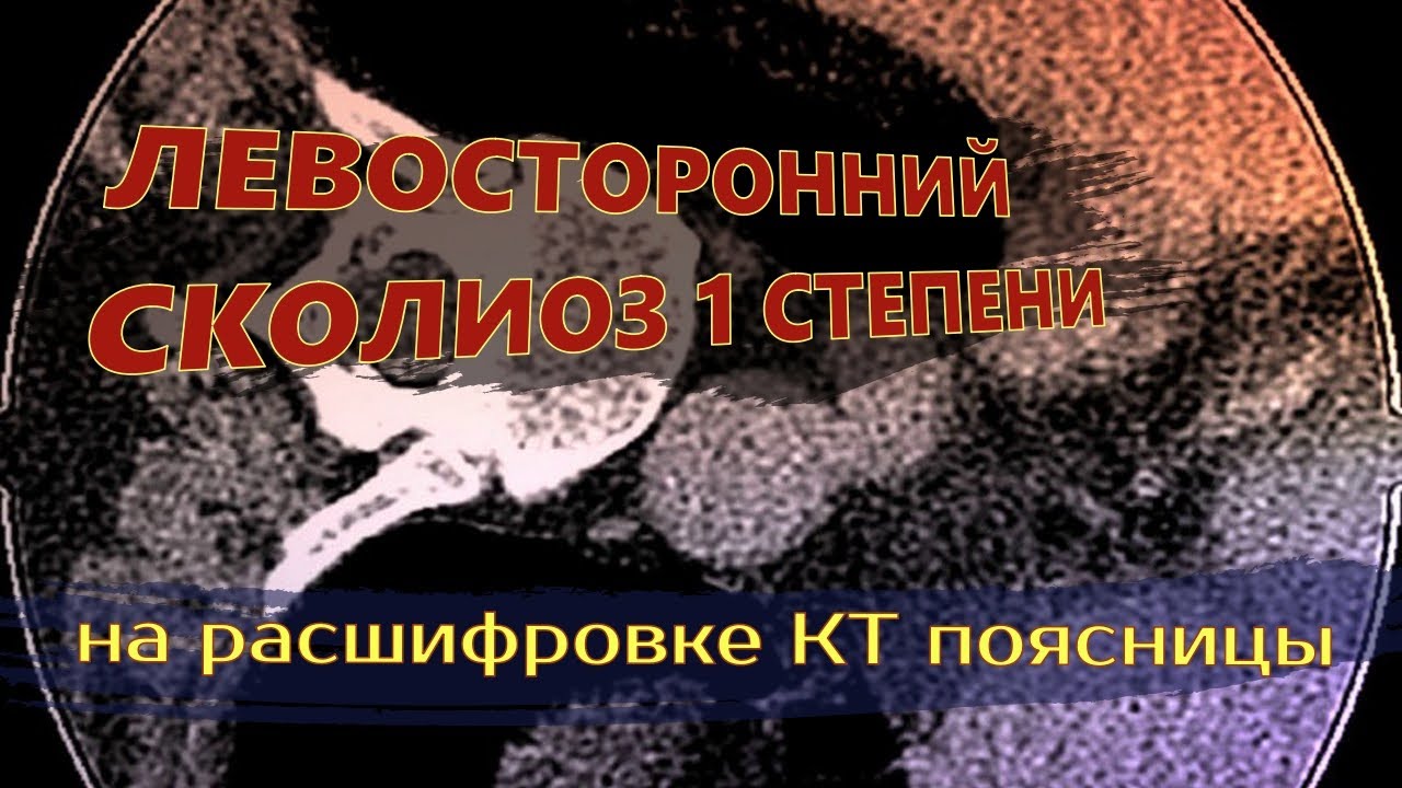ЛЕВОСТОРОННИЙ СКОЛИОЗ поясничного отдела 1 степени и ГРЫЖА l4 l5 l5 s1 ...