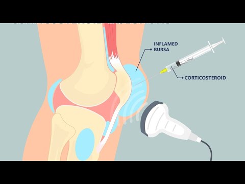 Video: Hvordan behandle subakromial bursitt