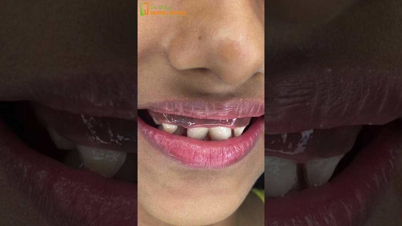 Early Assessment is Key for Optimal Jaw Growth in Children 🧒🦷