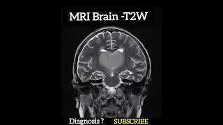 Diagnosis ? Mri Brain T2W Images - Practical Case - Radiology