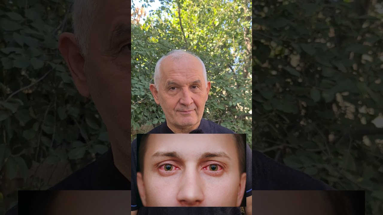 Конъюнктивит: как распознать?