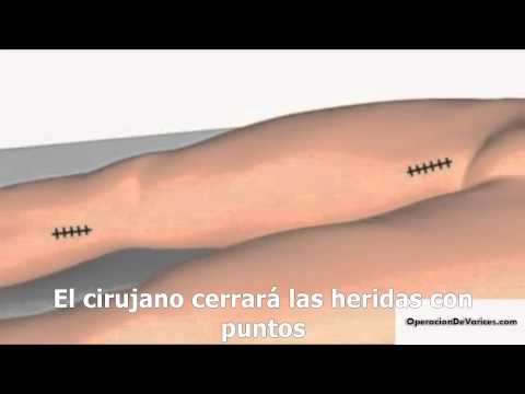 Laser varices postoperatorio cirugia