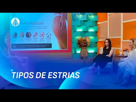 Como tratar estrias: soluções eficientes para o seu dia a dia | Viva a Tarde