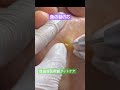 足裏の痛みの原因は魚の目でした‼️#魚の目 #用賀 #フットケア