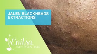 Jalen’s Blackheads Extractions (Nice and Clean)
