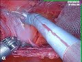 Robotic lower abdominal tarm meshplasty