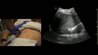 Right Upper Quadrant Abdomen, Coronal Views, Ultrasound Scanning Techniques