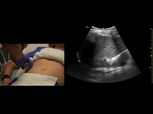 Right Upper Quadrant Abdomen, Coronal Views, Ultrasound Scanning Techniques class=