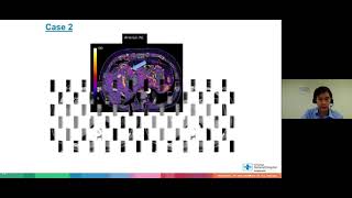 SURESubtraction Iodine Mapping in CT liver