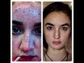 My History with Acne (Mi historia con Acne)II Shannon Sullivan