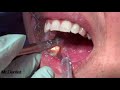 Root Canal Treatment - Part 2     !!!!