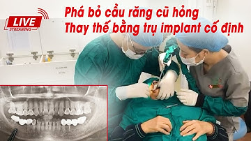 [Livestream] Trực tiếp thay thế cầu răng cũ hỏng bằng phương pháp cấy ghép trụ implant cố định