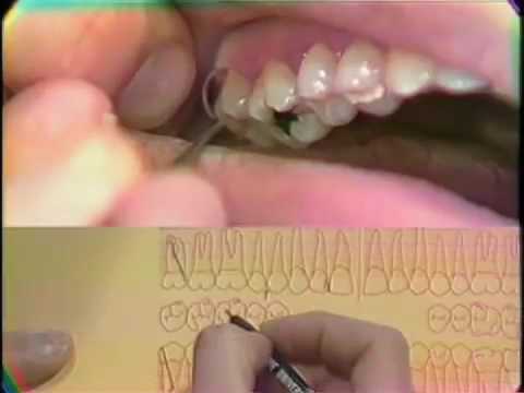Full Mouth Periodontal Charting