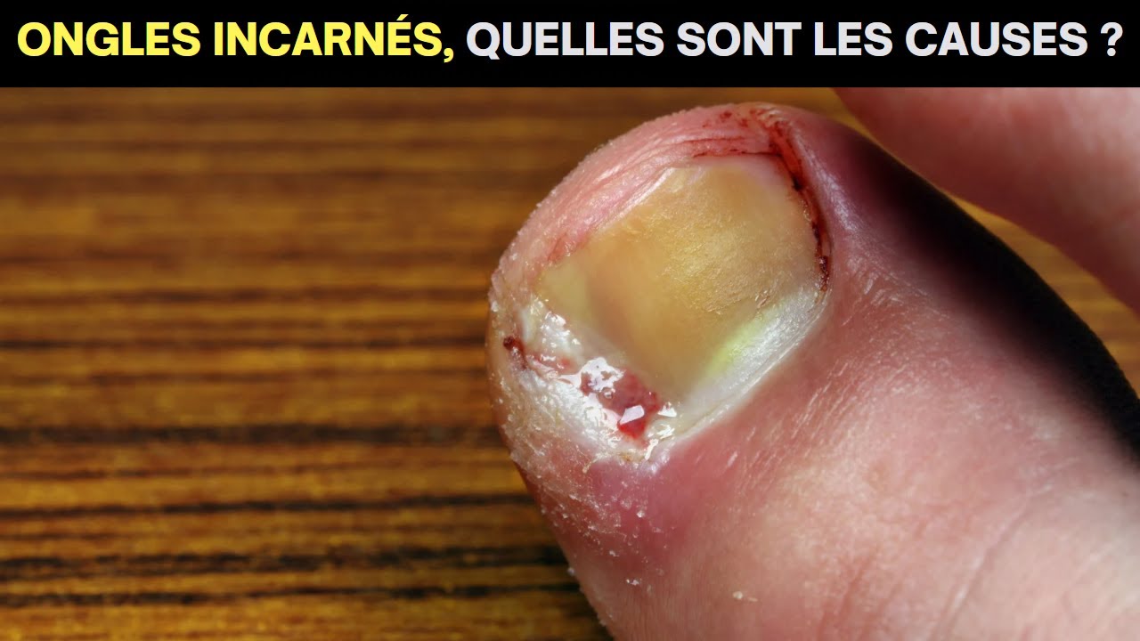 Conseils essentiels pour soulager la douleur d'un ongle incarné - YouTube