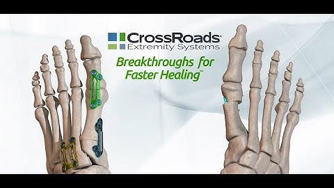 The First Ray by CrossRoads™ Animation - Now Featuring the dynaMet™ Lesser TMT Fusion System!