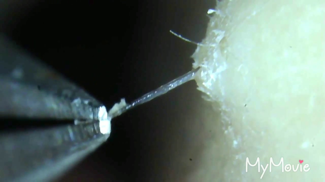Gross Compilation Of Plucking Roots Puss And Goo On Ingrown Hair