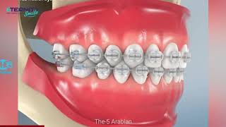 شاهد كيف تتحرك الأسنان عند عمل تقويم للأسنان