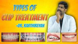 பல் கிளிப் சிகிச்சையின் வகைகள் | Types of Orthodontic Treatment | Denta Kings | Dr.Karthikeyan