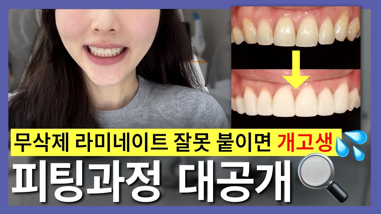 ()무삭제라미네이트 하기 전에 꼭 보세요❗ 실제 피팅과정 대공개💣