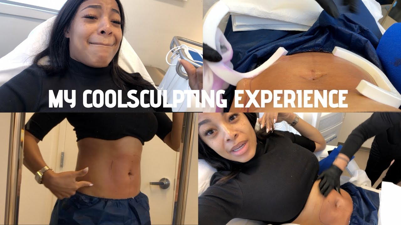 Мой первый опыт криолиполиза: видеоблог