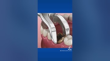 Nhổ răng sâu diễn ra như nào? #nhakhoa #shorts