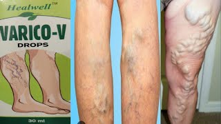 VARICO-V Drops | VARICOSE VEIN HINDI ME