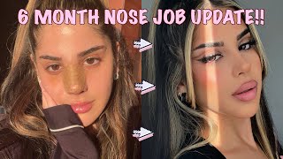 6 MONTH POST OP NOSE JOB UPDATE   Q&A *with discount code*