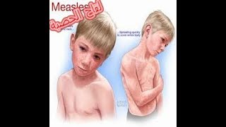 measles rubeola الحصبة