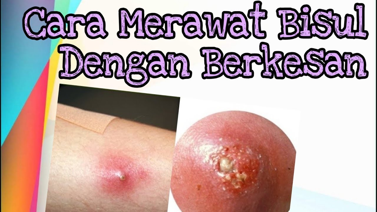 Cara Merawat Bisul Dengan Berkesan Supaya Tak Berulang Youtube