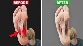 Youre Treating Plantar Fasciitis WRONG (Do This)