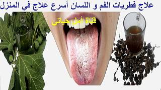 علاج فطريات الفم و اللسان اسرع علاج في المنزل