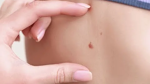 10 simptomat e kancerit te gjirit qe nuk duhet ti ...
