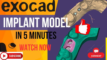 Exocad Tutorials : Implant Model in Exocad in 5 Min. #exocad #implants #shorts