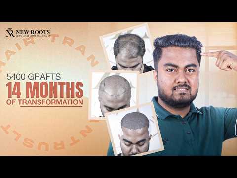 The Most Natural Hair Growth You'll See Today 😱 | Hair Transplant in Bangladesh | New Roots