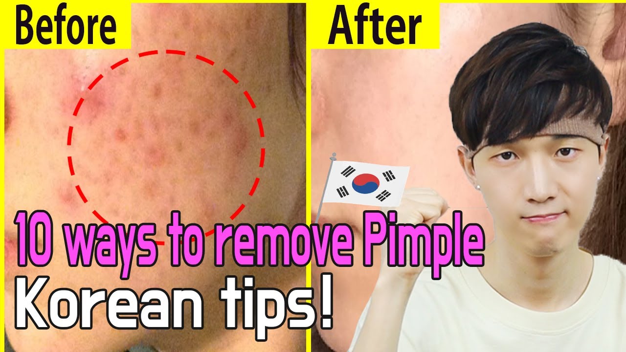 koreans with pimples