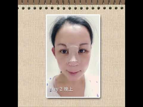 維納斯時尚診所-首爾鼻王手術，自體軟骨隆鼻全記錄