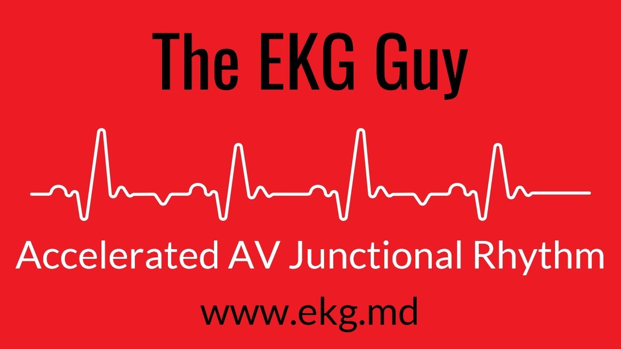 Accelerated AV Junctional Rhythm EKG l The EKG Guy www.ekg.md YouTube