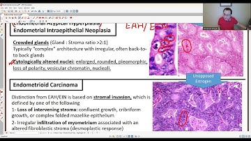 GYN PATHOLOGY: ENDOMETRIAL TUMORS 1