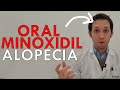 DOCTOR te cuenta MINOXIDIL ORAL para tu ALOPECIA