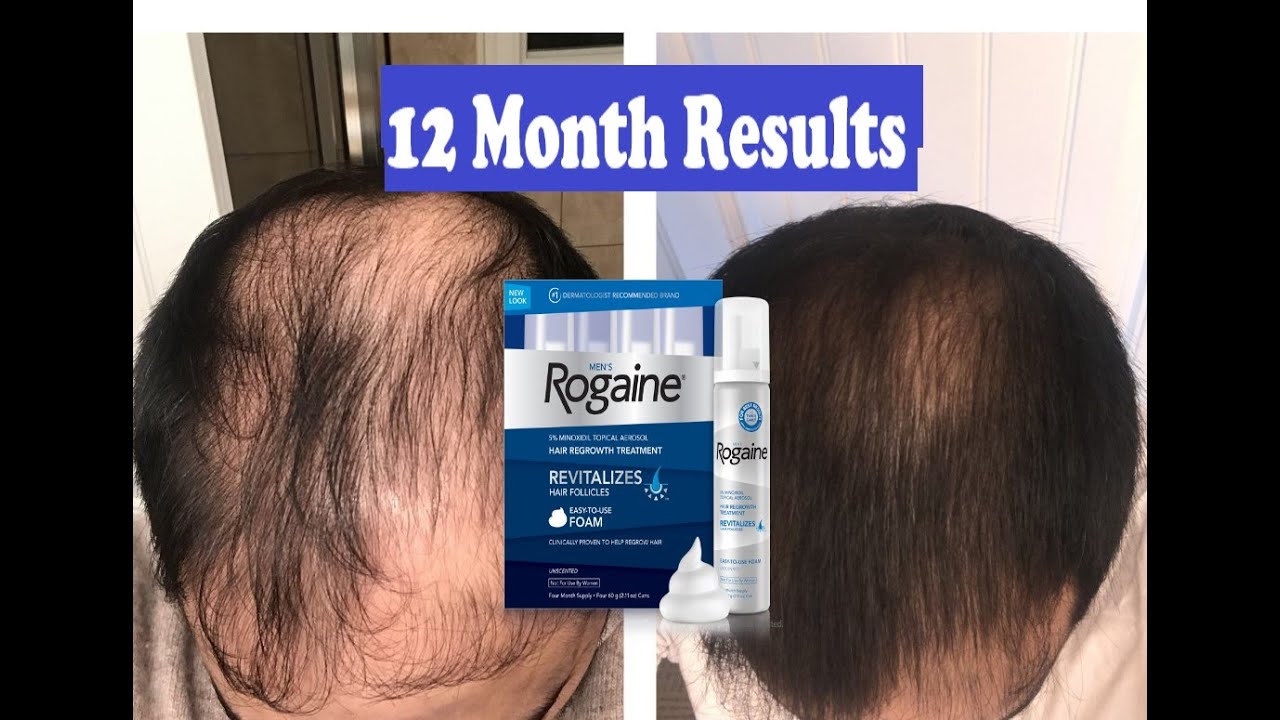 does-rogaine-really-work-12-month-results-mens-rogaine-5