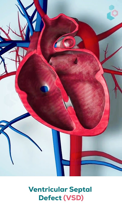 Ventricular Septal Defect Surgery ↪ 3D Medical Animation #Shorts #VSD #VentricularSeptalDefect