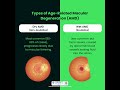Age-Related Macular Degeneration (AMD) – Know the Signs & Treatments!