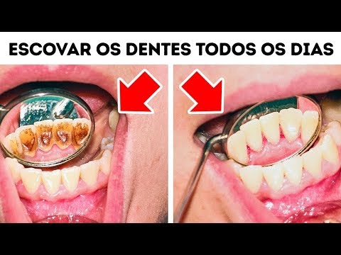 Vídeo: Manter Os Dentes Saudáveis: Tratar Ou Prevenir?