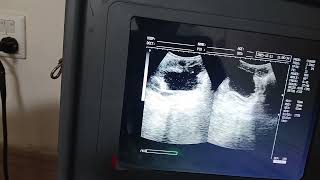 How to calculate the post void residual volume. #usg #ultrasound 
