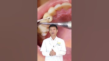 Bắt Con Sâu Trong Răng?!