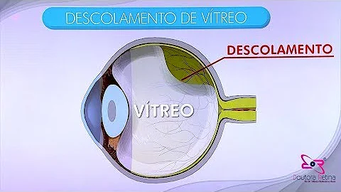 Onde fica o vítreo no olho?