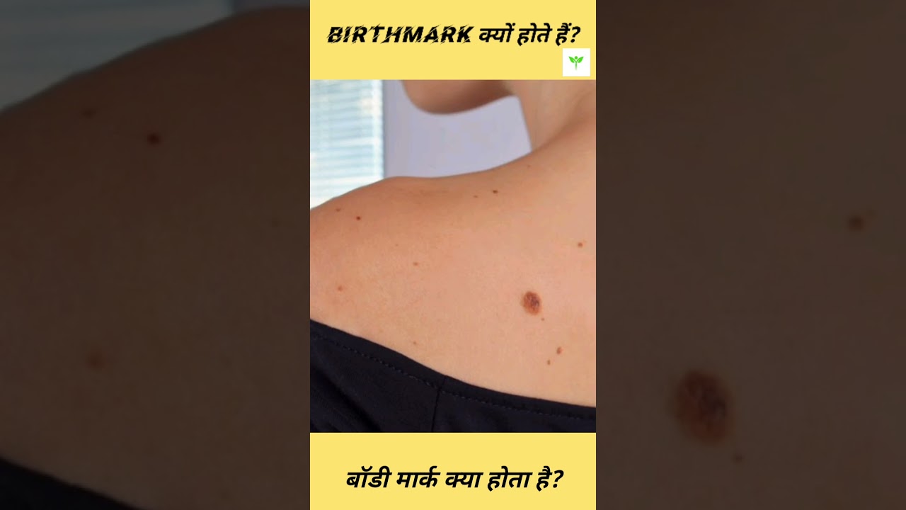 Birthmark क्या होता है? || Secret of Birthmark || Nourish Ayurveda 