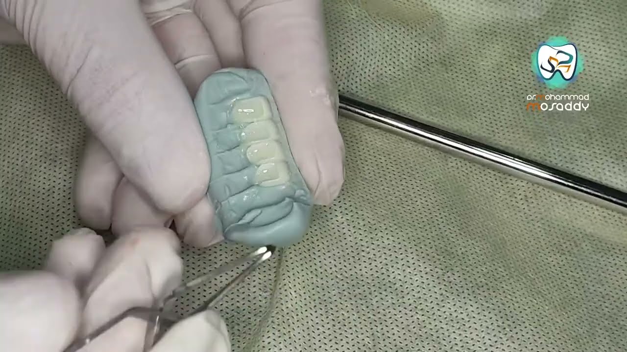 الصاق فينيرات أمامية veneer